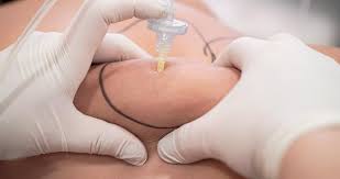 30 Sessões de Carboxiterapia + Infrared + Reeducação Alimentar